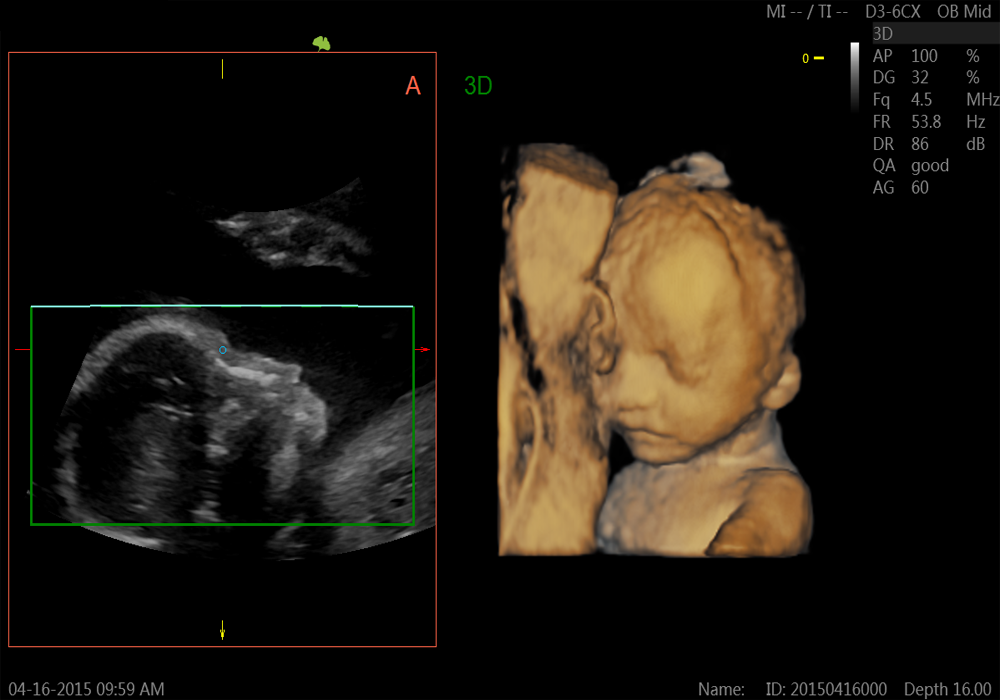 Fetal face 3D/4D