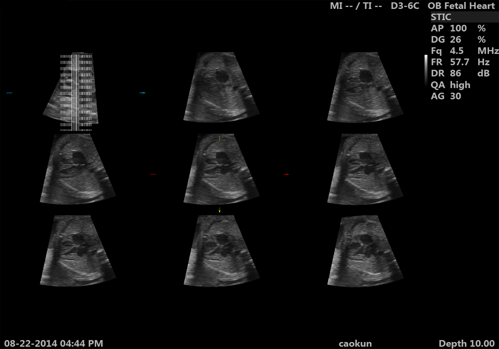 Fetal heart STIC